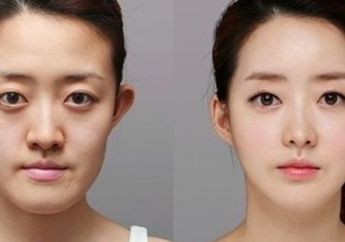 Meskipun Masih 15 Tahun, Ini Jumlah Uang yang Biasanya Dihabiskan Remaja Korea untuk Operasi Plastik
