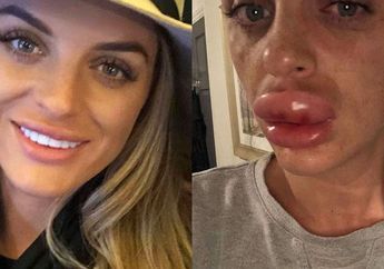 Suntik Filler di Sebuah Pesta, Bibir Perempuan Ini Bengkak 5 Kali Ukuran Normal!