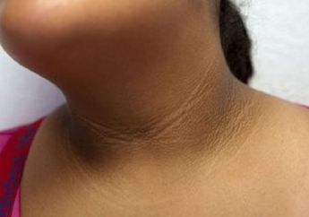 Bukan Masalah Tidak Bersih, Kulit Leher Belakang Menebal dan Terlihat Hitam Bisa Jadi Tanda Penyakit Berbahaya Ini!