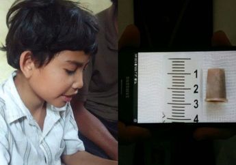 Kisah Asep Yaya, Bocah Bandung Bersuara Terompet, 2 Bulan Susah Bernapas hingga Dibully Teman Sekolahnya