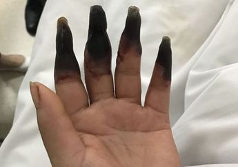 Terkena Infeksi Langka, Jari-Jari Wanita ini Menghitam Seperti Membusuk!
