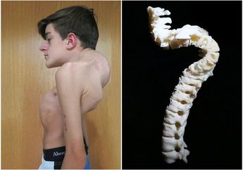 Sudah 17 Tahun Menderita Tulang Belakang 'Memutar', Akhirnya Remaja Ini Dioperasi dan Begini Tampilannya Kini