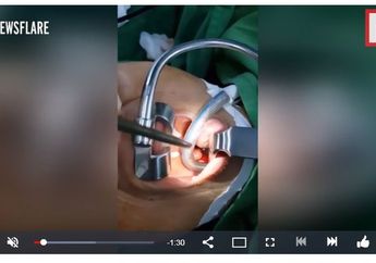 Dikira Tumor Tenggorokan, Saat Dioperasi Dokter Justru Temukan Lintah di Dalam Sinusnya