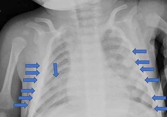Keji! Bayi 4 Bulan Disiksa Orangtuanya Hingga Alami 28 Patah Tulang!