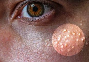 Bintik-bintik Putih di Sekitar Wajah Anda, Begini Cara Menghilangkannya Secara Alami