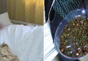 Jarang Sarapan! Wanita ini Alami Kondisi Medis Mengerikan, 2.000 Batu Empedu Keluar dari Perutnya