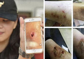 Ngeri! Datangi Panti Pijat, Sekumpulan Pria ini Justru Terinfeksi Bakteri Kulit Mengerikan