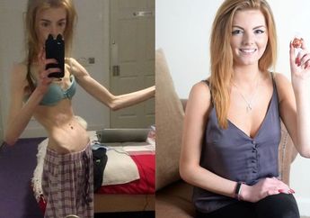 Kisah Annie Windley, Derita Anorexia Hingga Hidupnya Terselamatkan Oleh Sebatang Cokelat