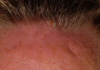 Ngeri! Gara-gara Pakai Handuk Basah Saat Liburan, Dahi Wanita Ini Jadi "Sarang" Belatung