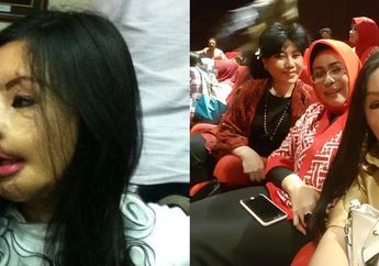 Sempat Hilang, Kini Kabar Lisa Face Off yang Disiram Air Keras Kembali Mencuak