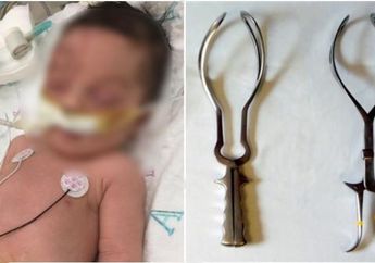 Kepala Bayi Terputus Saat Jalani Persalinan Forsep, Siapa yang Harus Disalahkan?