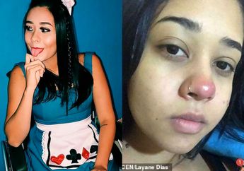 Dokter Kaget Temukan 500 Miligram Nanah di Tulang Belakang Gadis Ini Usai Lakukan Tindik Hidung dan Jadi Lumpuh