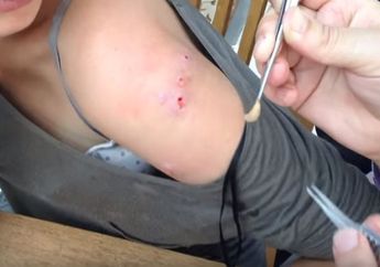 Usai Pulang Berlibur, Lengan ini Wanita ini Jadi Berlubang dan Ada Hewan Menjijikkan ini Bersarang, Mahkluk Apa itu?