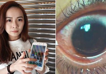 Mata Wanita ini Berakhir Mengerikan, Akibat Bermain Ponsel dengan Kecerahan Layar Maksimal!