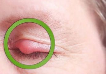 Nggak Perlu Repot, Hilangkan Mata Bintit dengan Obat Ramuan Alami Berikut