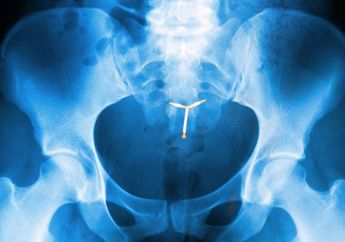 Wanita Ini Harus Kehilangan Rahim dan Jari Kakinya Karena Pemakaian Alat Kontrasepsi IUD; Ini Efek Samping Pemakaian IUD