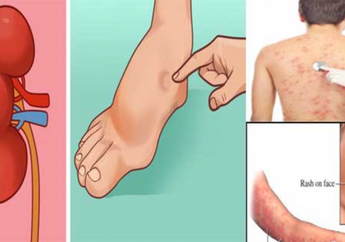 Sering Kedinginan Hingga Kulit Gatal, Berikut 8 Gejala Awal Gagal Ginjal yang Wajib Kamu Perhatikan!