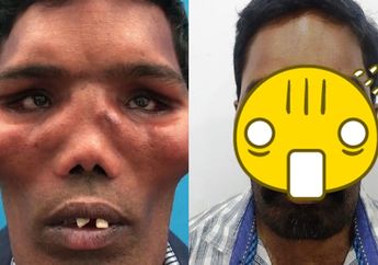 Punya Penyakit Langka Hingga Memiliki 'Wajah Singa', Intip Transformasi Pria ini Setelah Operasi