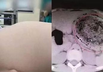 Kebiasaan Makan Rambut Sendiri Sejak Usia 2 Tahun, Dokter Temukan Hal Ngeri ini di Dalam Perutnya