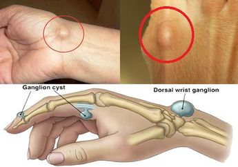 Miliki Benjolan Pada Tangan dan Kaki Seperti ini? Ternyata Begini Penjelasan Medisnya!
