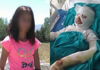 Ngeri! Niatnya Ingin Basmi Kutu Rambut dengan Bensin, Seorang Gadis Berusia 16 Tahun Justru Terbakar