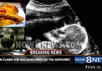 Dapat Bertahan Hidup di Kandungan Tanpa Air Ketuban, Sang Ibu Malah Menyebut Anaknya Itu Bayi Setan