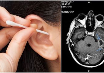 Nyesel! Pakai Cotton Bud untuk Korek-korek Telinga, Wanita Ini Alami Infeksi Bakteri Parah yang Gerogoti Tengkoraknya, Begini Akhir Nasibnya!