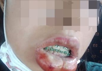 Pakai Kawat Gigi Palsu, Bibir Seorang Wanita Bengkak Tak Karuan Dipenuhi Nanah