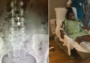 Alat Kontrasepsi Hancur di Perut, Indung Telur Wanita Ini Menghitam Serta Kaki dan Tangannya Membusuk