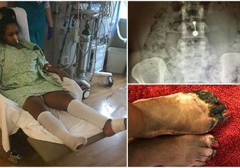 Akibat KB Spiral Masuk ke Perut, Kaki Wanita Ini Terpaksa Diamputasi dan Menghitam