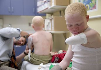 Tragis! Anak Albino di Afrika Jadi Buruan Untuk Diambil Bagian Tubuhnya yang Dianggap 'Bertuah'