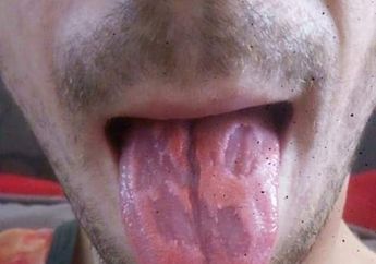 Setiap Hari Tenggak Minuman Energi 6 Kaleng, Lidah Pria Ini Melepuh Gegara Menyerap Kandungan Gula di Dalamnya