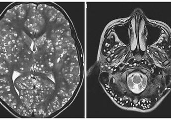 Diduga Gemar Lahap Daging Babi Setengah Matang, Remaja Tewas Usai Otaknya Digerogoti Cacing Pita