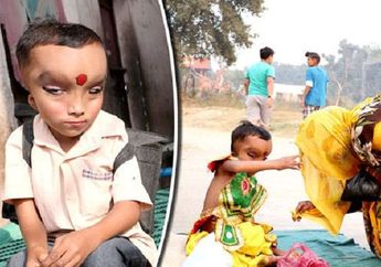 Alami Kelainan Fisik, Bocah di India ini Justru Disembah dan Dianggap sebagai Titisan Dewa Ganesha