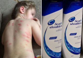 Hanya Bermodalkan Sampo, Ibu Ini Bagikan Trik Luar Biasa Mengobati Gejala Cacar Air Anaknya, Bagaimana Ya Caranya?