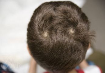 Sering Dianggap Pertanda Anak Nakal, ini 5 Fakta Unyeng-unyeng di Kepala yang Wajib Kamu Tahu!