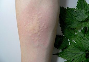 Obat Biduran dengan Antihistamin Alami yang Mudah dan Murah, Mau?