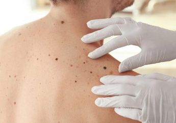 Tidak Disadari, Tahi Lalat dengan Ciri dan Warna Seperti Ini Bisa Berubah Menjadi Kanker Ganas, Harap Waspada!