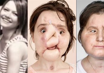 Jalani Operasi Hingga 31 Jam, Katie Jadi Orang Termuda yang Terima Transplantasi Wajah