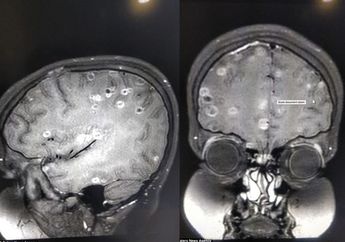 Telur Cacing Pita Bersarang di Otak Seroang Anak, Kebiasan Sepele ini Bisa Jadi Pemicunya