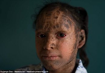 Kisah Gadis Ular Asal India yang Mengucilkan Diri Lantaran Mengidap Kelainan Kulit Langka