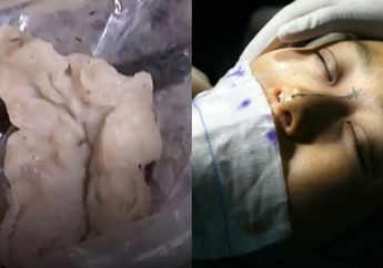 Usai Jalani Operasi Plastik, Wanita ini Bersin dan Keluarkan Benda Berlendir