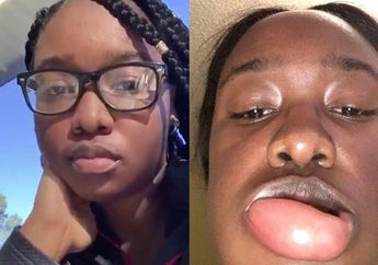 Awalnya Dianggap Bengkak Biasa, Ternyata Remaja ini Alami Penyakit Berbahaya