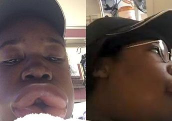 Usai Makan Burger, Bibir Remaja Ini Terus Membengkak Tiap Jam