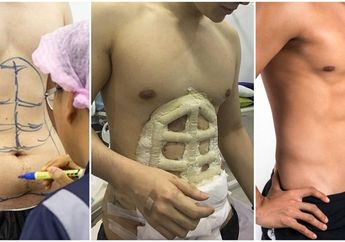 Laku Keras di Thailand, Operasi Six Pack Ini Digandrungi untuk Peroleh Tubuh Ideal dengan Cara Spontan!