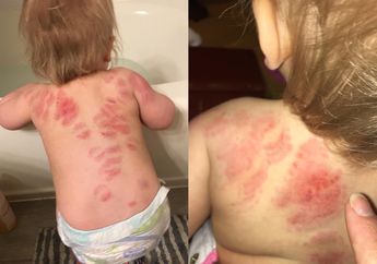 25 Bekas Gigitan Ditemukan di Punggung Bayi Usai sang Ibu Mengambilnya dari Tempat Penitipan Anak, Faktanya Bikin Syok!