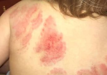 Dititipkan di Tempat Penitipan Anak, Pulang-pulang Tubuh Balita Ini Dipenuhi Luka Gigitan