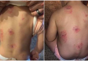 Diacuhkan Gurunya, Seorang Balita Digigit 8 Kali oleh Temannya Hingga Bentuk Gigi Membekas di Punggungnya!