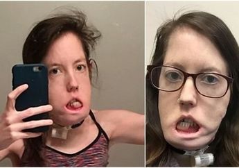 Dianggap Tak Mampu Bertahan Lebih dari Setahun Akibat Kista, Kenyataannya Malah Begini