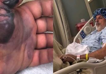 Lakukan Wisata dengan Perahu, Pria ini Pulang dengan Bakteri Mengerikan yang Memakan Dagingnya